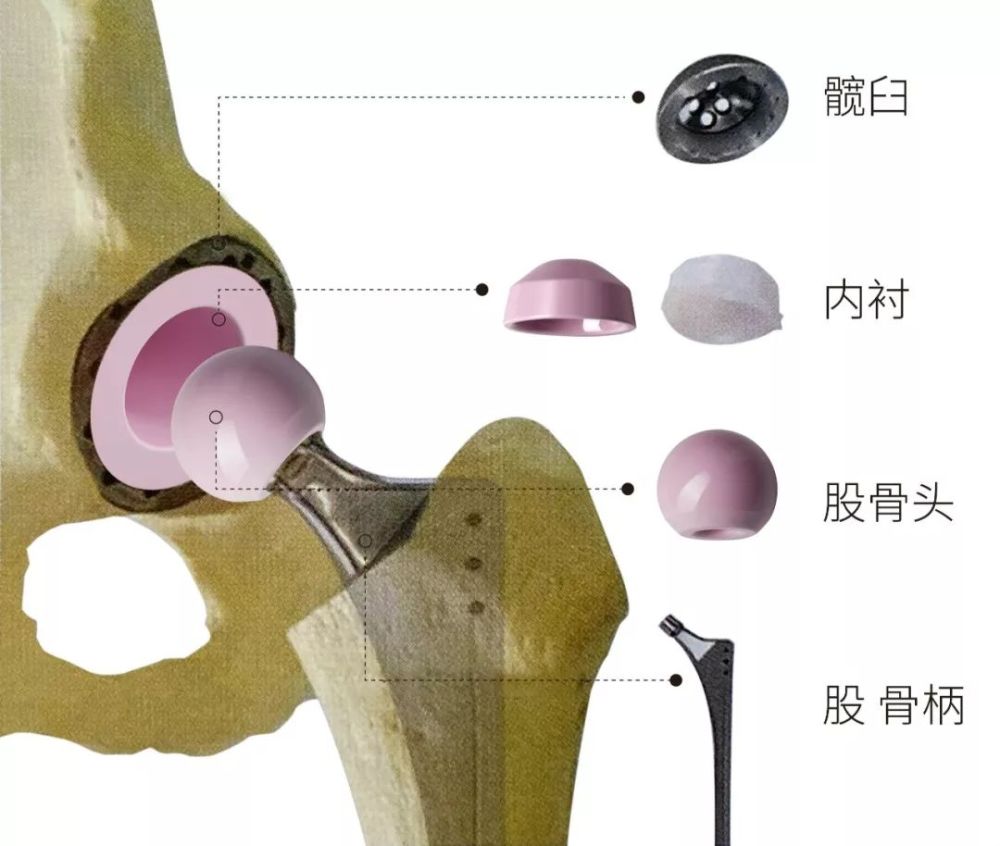 骨关节炎外科治疗手段——人工关节置换术