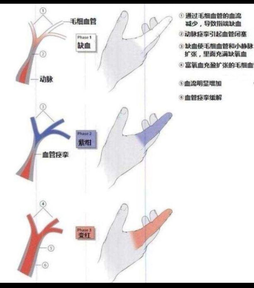 "雷诺现象"以手指发病最常见