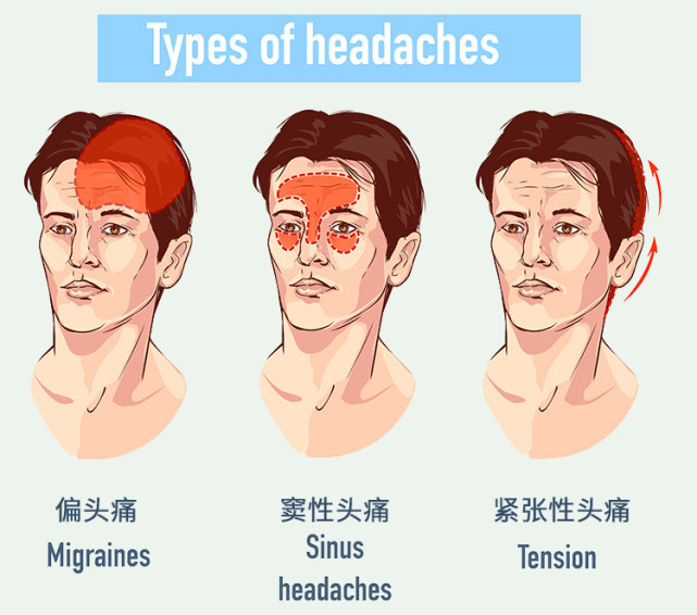 原发性头痛通常不知道确切的病因,例如,丛集性头痛,偏头痛,紧张型头痛