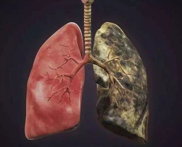 肺癌不是悄无声息,手指出现3种"异常",最好查一下肺部ct!