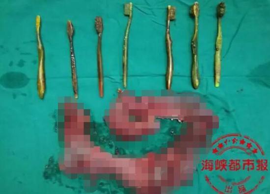 大龄女子肚中取出7把牙刷 疑遭逼婚多次吞异物解压