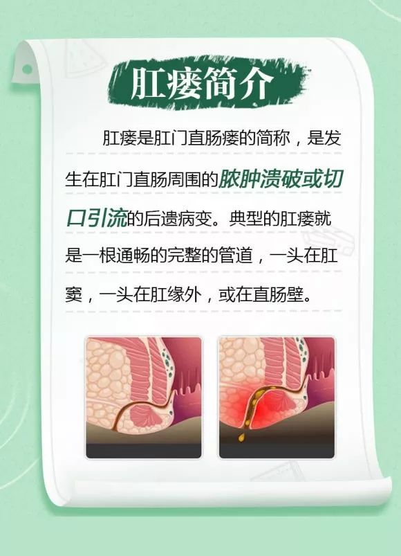 患上肛瘘咋办牢记五点堵瘘不手软