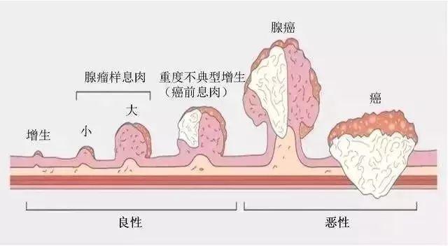 看完这篇,了解息肉的全部