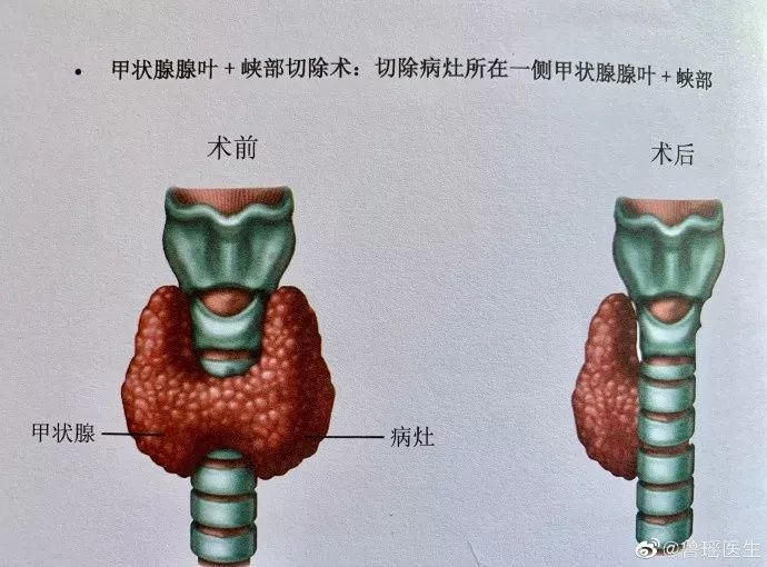 术中见肿物位于甲状腺右叶下极,形态特征与b超描述一致.