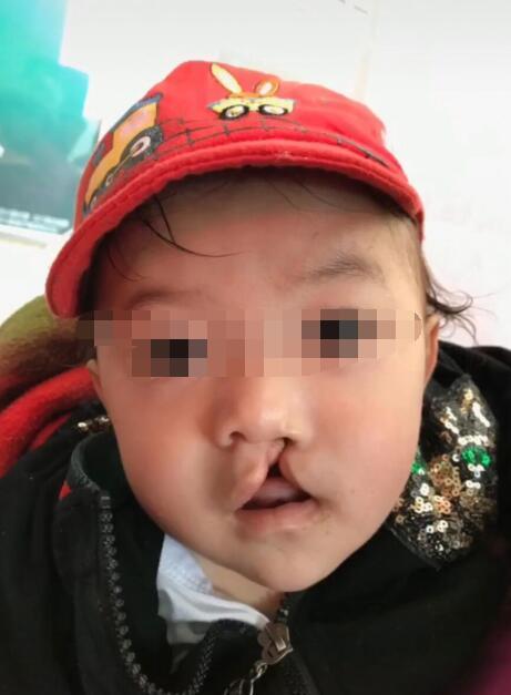 兔唇是咋形成的组图清晰展示三种妈妈易中招一种跟爸爸有关