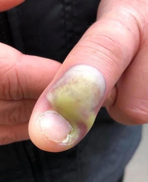 咬指甲吗?苏格兰南子因长期咬指甲导致感染,最终手指被截肢