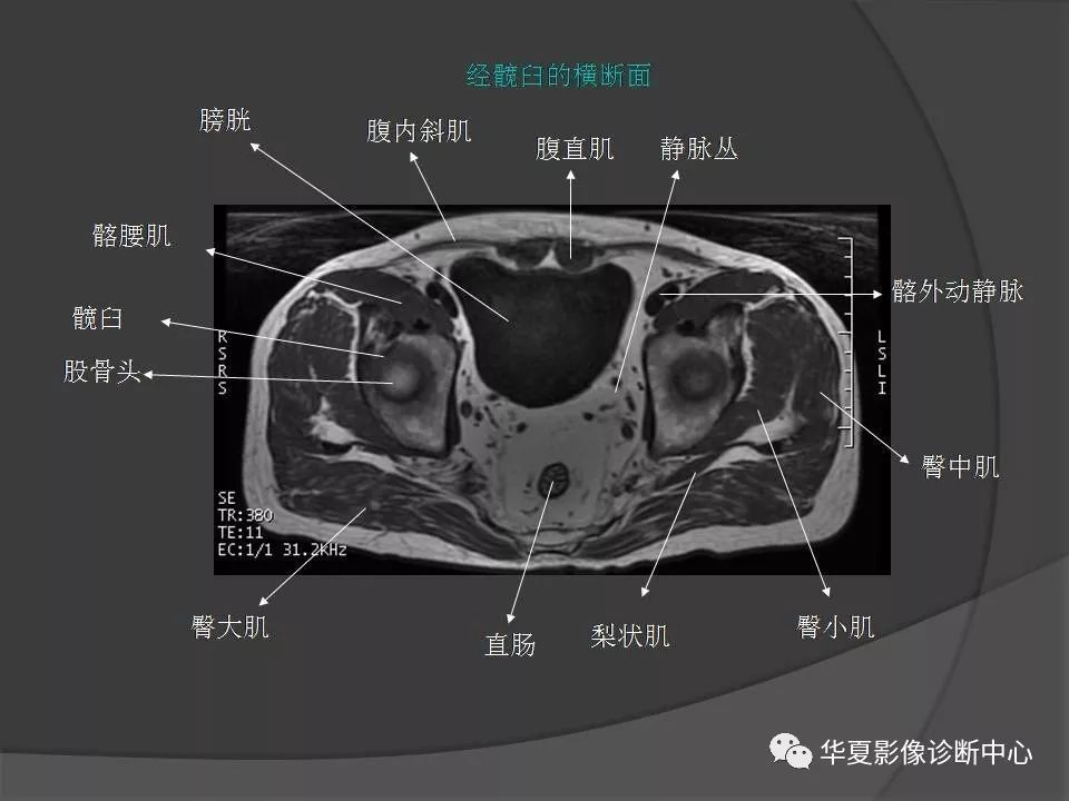 骨盆肌肉解剖mri标识