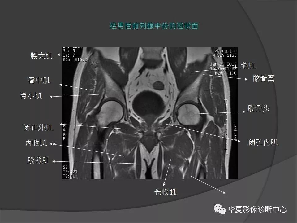 mri解剖系列骨盆肌肉解剖