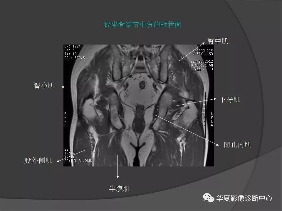 mri解剖系列骨盆肌肉解剖