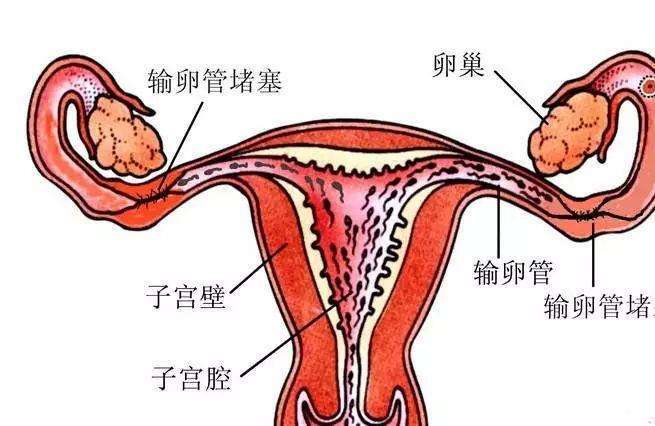 41岁输卵管堵塞可以直接做试管婴儿吗?