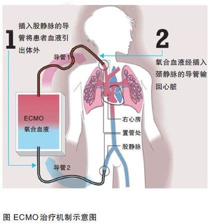 人工肺ecmo