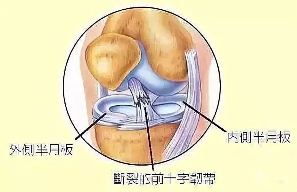 膝关节为什么那么脆弱?附膝关节解剖详情