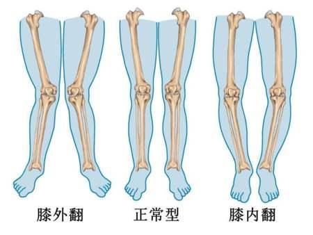 走路x形腿深蹲膝盖内扣3步让膝盖远离疼痛