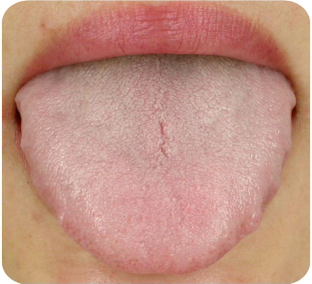 注意 湿气重的人舌苔厚腻,使用黄芪易阻滞气机,加重不适,因此痰湿