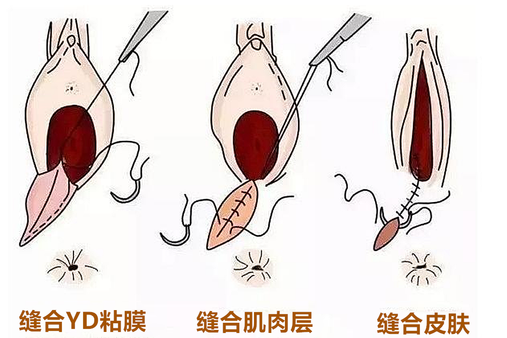 分娩时"侧切"和"撕裂",对生活是否有影响?助产士说了实情