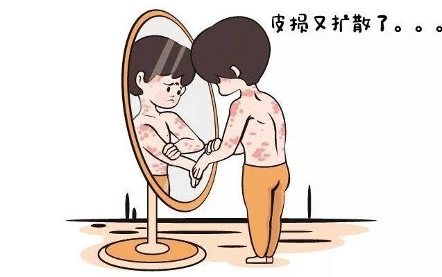 生活中如何来预防银屑病的扩散呢?