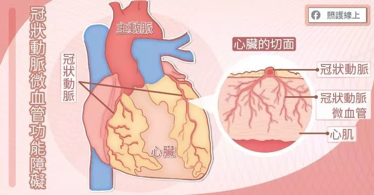 男女性心脏病症状不同!女性更要注意心血管疾病