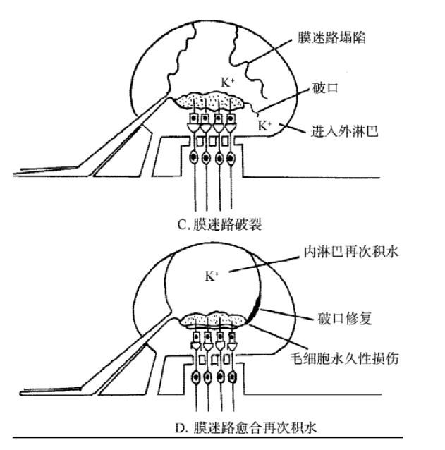 梅尼埃病膜迷路破裂学说示意图