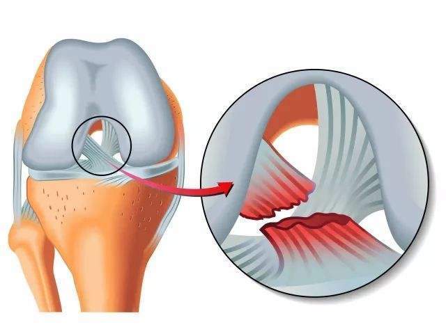 使胫骨过度向后移位,可引起后十字韧带损伤,甚至发生膝关节后脱位