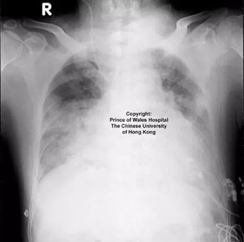 一些病人也会罹患永久性的肺损伤.