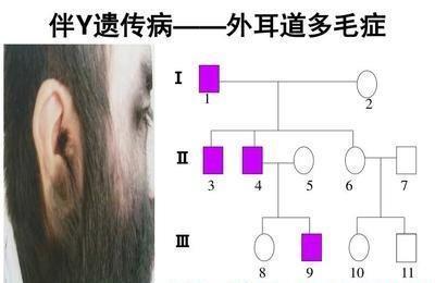 图七 外耳道多毛症遗传图谱