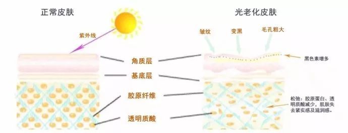 光老化是由于皮肤长期受到日光照射所引起的损害