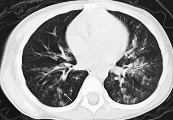 新冠病毒,肺炎支原体……不同病原体所致的儿童肺炎,ct 表现有何特点?
