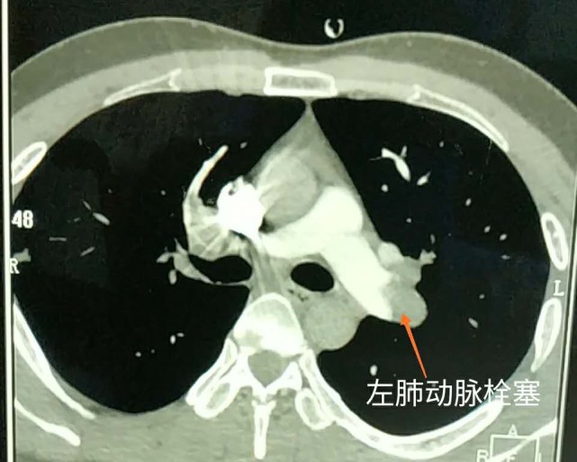 患者肺动脉ct图片