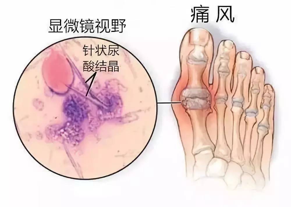 痛风为什么总是先从脚痛起?脚痛暗示的问题还不小,别掉以轻心