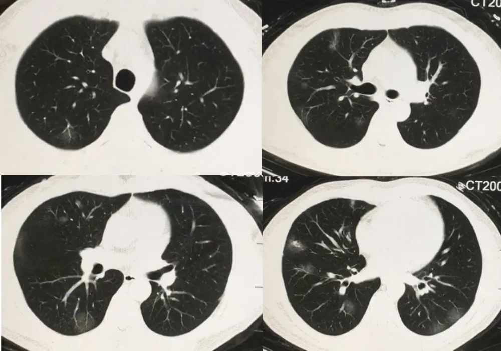 刘敏:病毒性肺炎的ct影像学特征分析