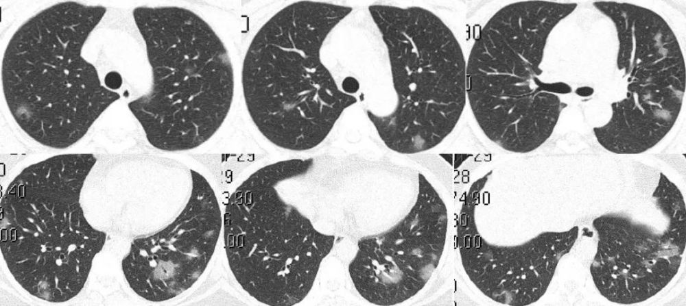刘敏:病毒性肺炎的ct影像学特征分析