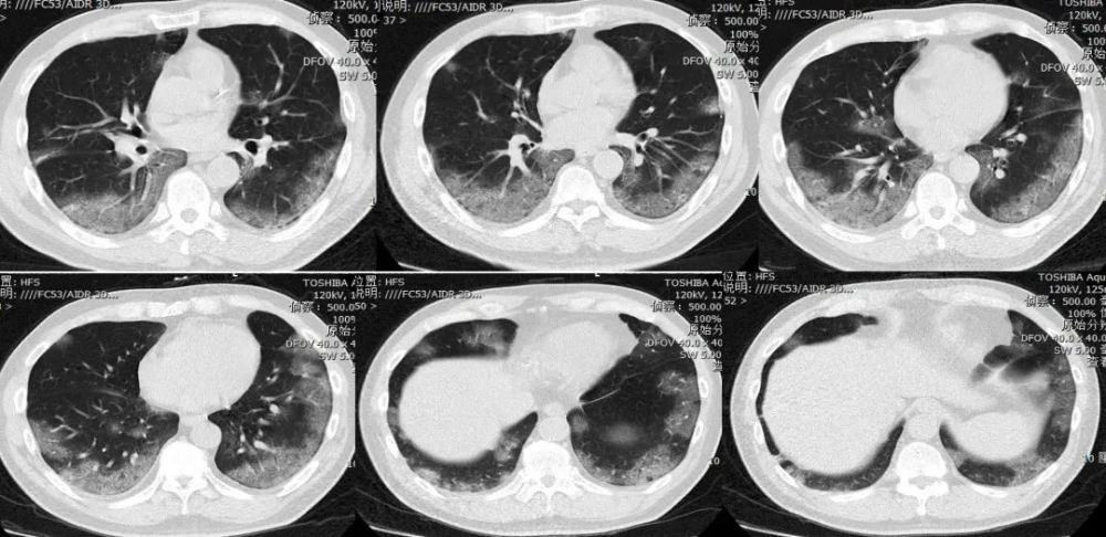 刘敏:病毒性肺炎的ct影像学特征分析