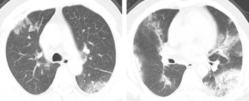刘敏:病毒性肺炎的ct影像学特征分析