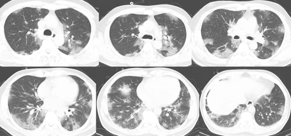刘敏:病毒性肺炎的ct影像学特征分析