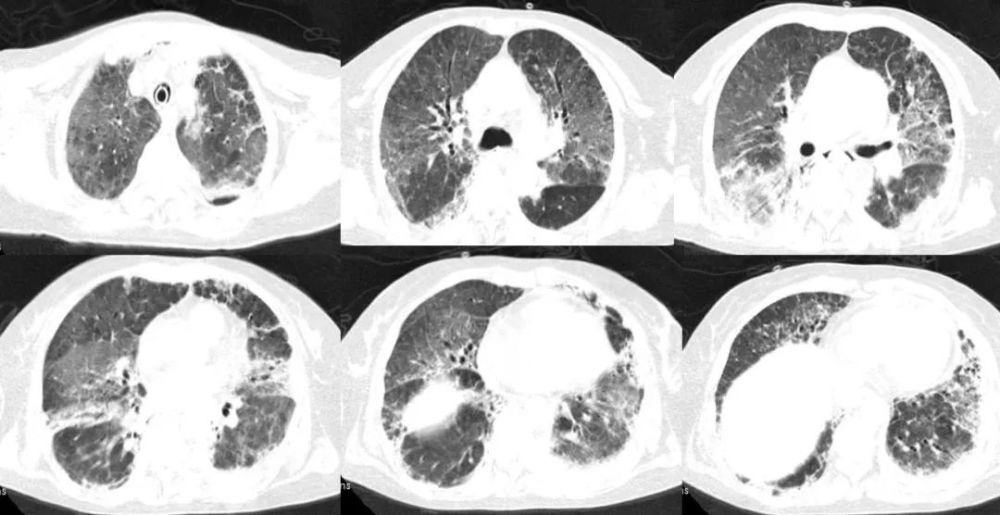 刘敏:病毒性肺炎的ct影像学特征分析