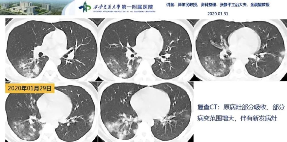 刘敏:病毒性肺炎的ct影像学特征分析