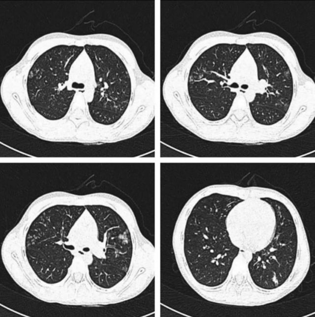 刘敏:病毒性肺炎的ct影像学特征分析