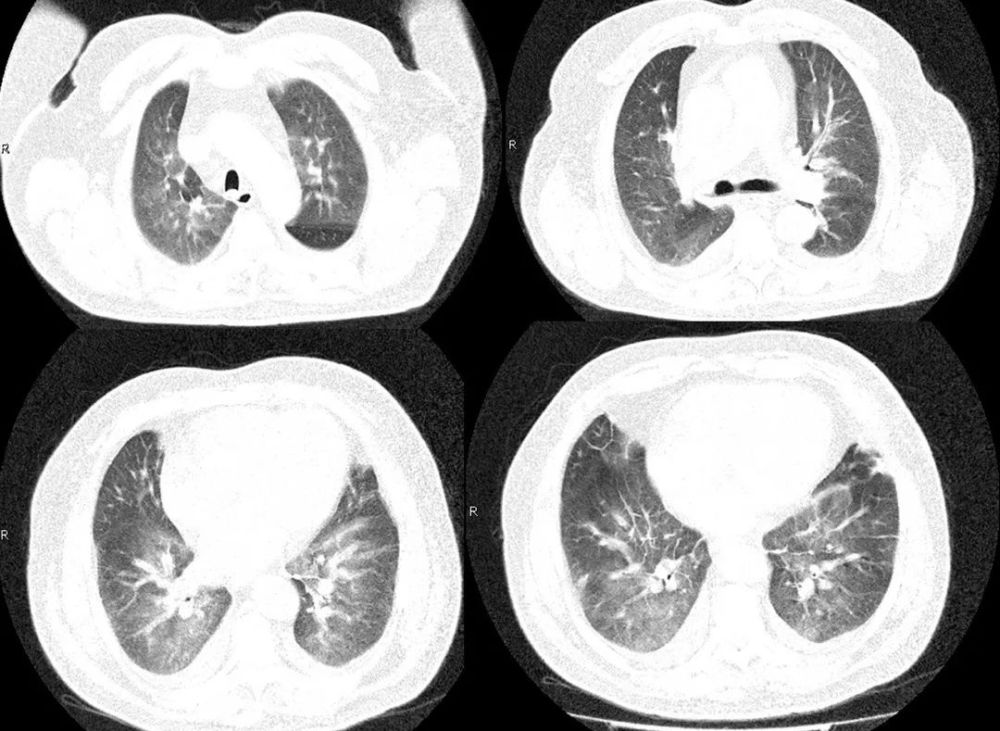 刘敏:病毒性肺炎的ct影像学特征分析
