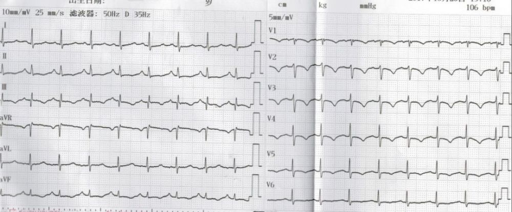 入院时心电图 心电图解读:窦性心动过速,siqiiitiii 征(即 i 导