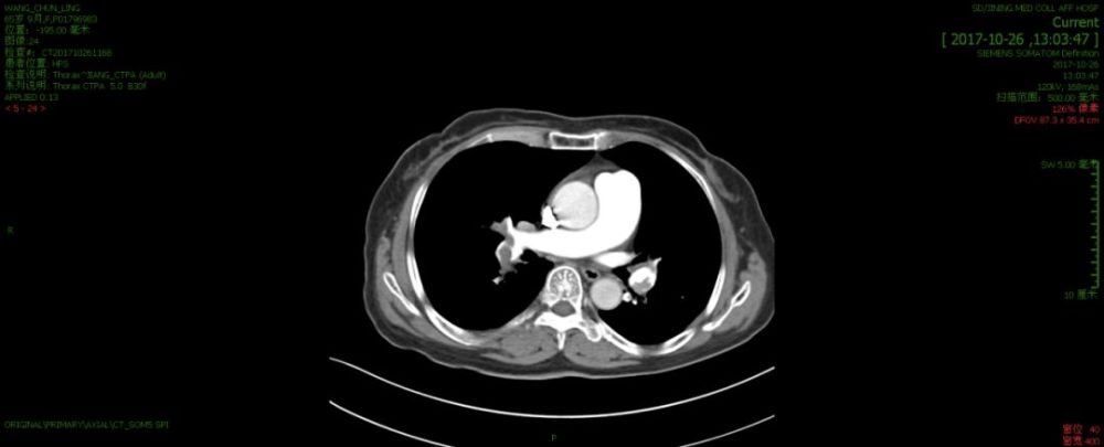 高危心电图只知道 ST 抬高?这 10 种情况
