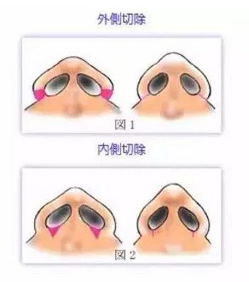 朝天鼻矫正示意图