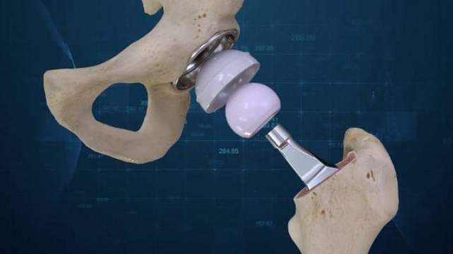 髋关节置换是怎么回事什么是人工髋关节置换