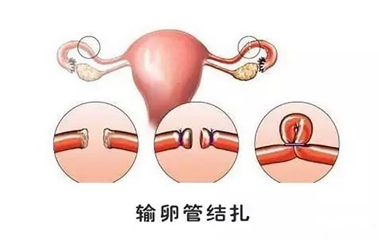 永久性的节育措施,目前流行的结扎术式对输卵管血管损伤小,成功率高