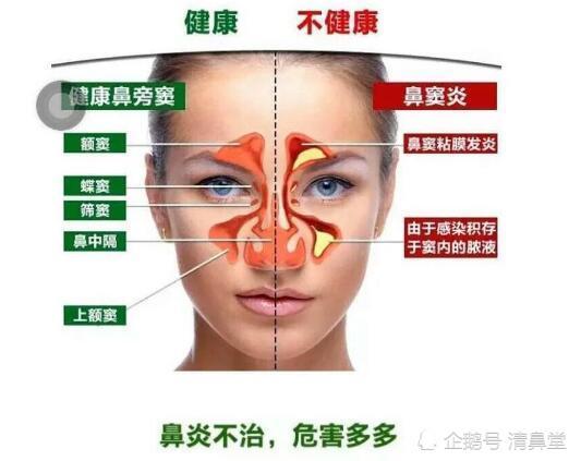 轻视鼻窦炎的后果有多严重?