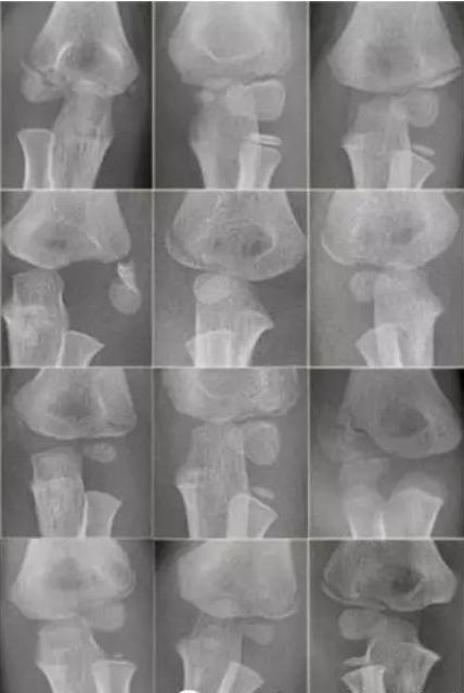 儿童肘关节骨折