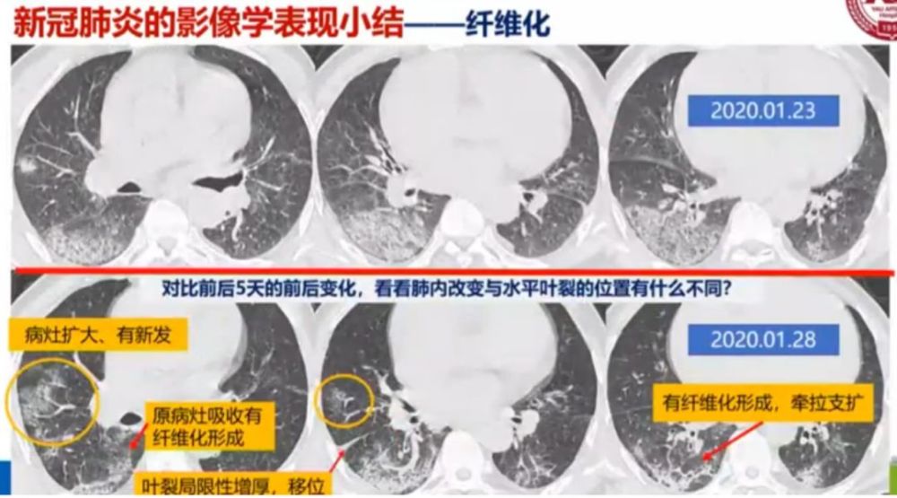 新冠肺炎影像学的13种特点,这篇文章为你总结全了!