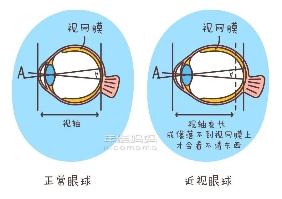 如果阳光接触不足,视轴(眼球前部到后部的距离)就会变长,导致近视.