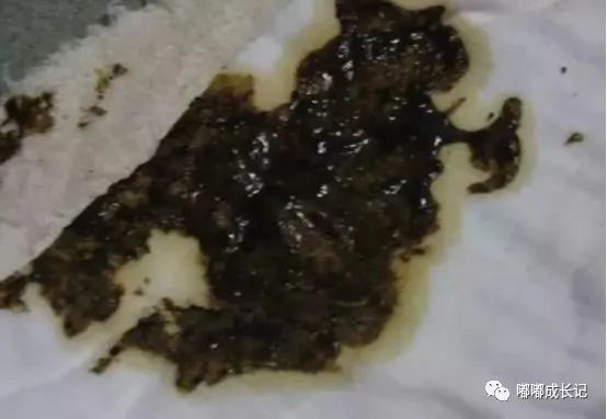 黑色大便 如果没有吃富含铁剂或者是颜色特别深的食物