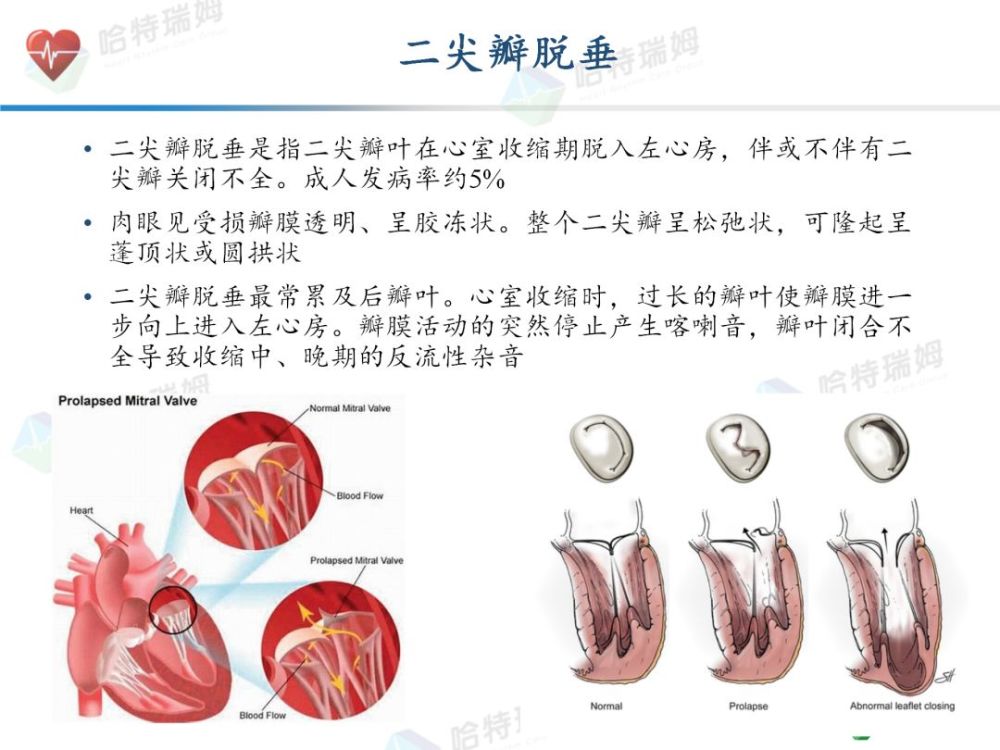 退行性mr(dmr):指由于二尖瓣瓣膜结构的退行性病变,如腱索拉长,腱