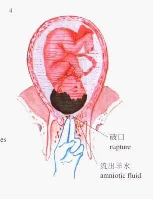 图解妇产科小手术18人工剥膜术和人工破膜术